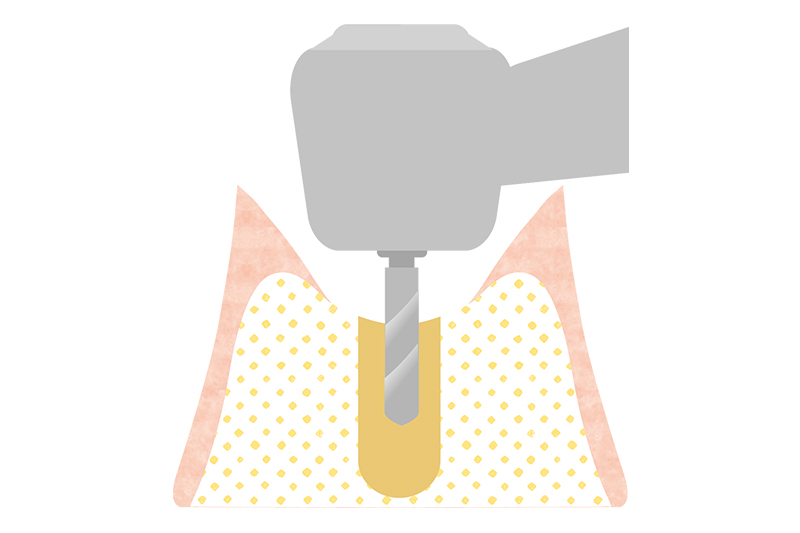 歯肉を切開することで、インプラントを挿入する穴をあけます。