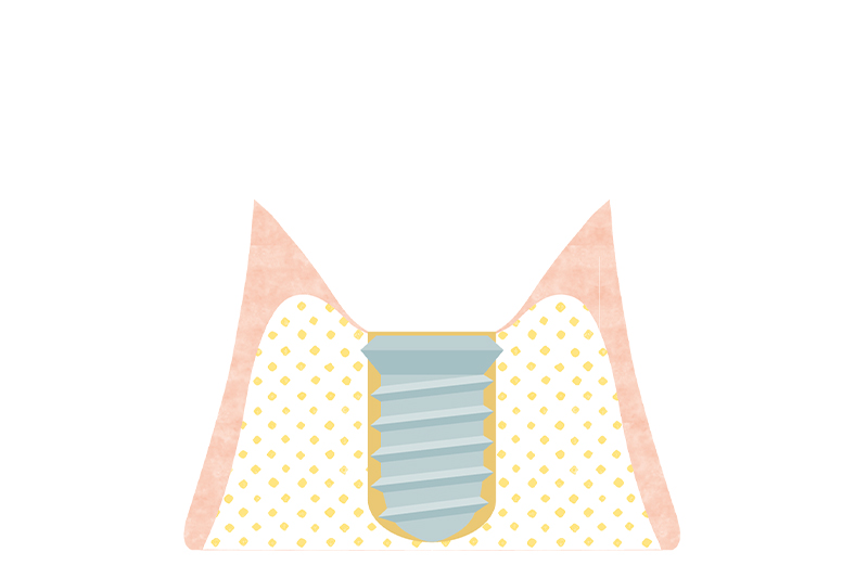 歯肉を切開した穴にインプラント体を埋込します。