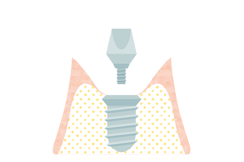 再度切開してアバットメントを連結させます。切開した歯肉の傷口の治癒期間約3ヶ月～6ヶ月待ちます。