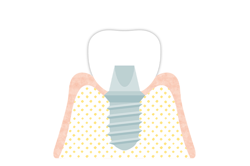 人工歯冠を装着し、インプラント治療が完了となります。