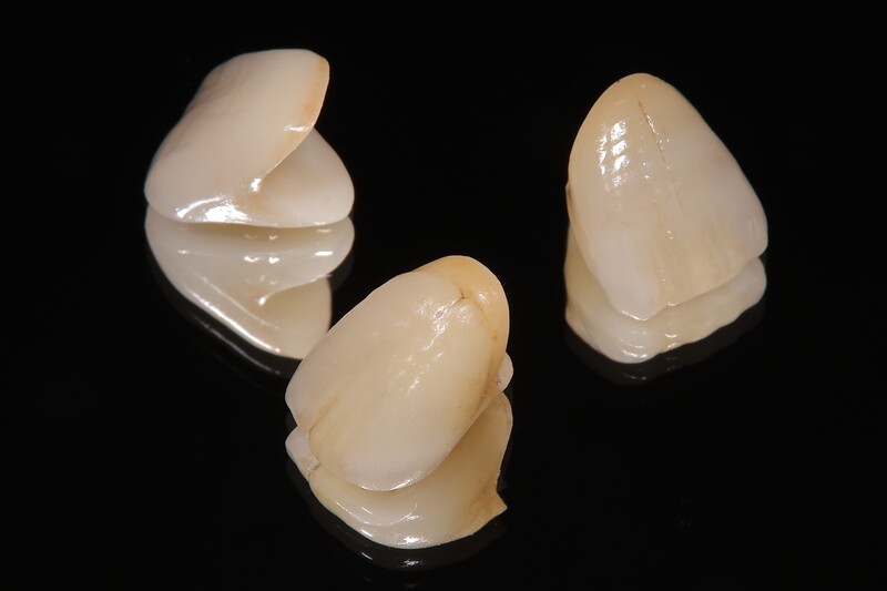 オールセラミッククラウン・ジルコニアクラウン